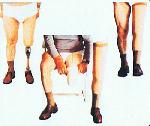 KNEE DISARTICULATION