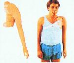 SHOULDER DISARTICULATION